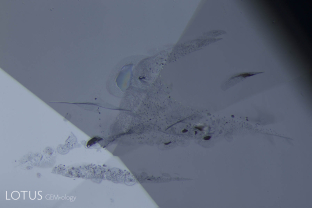 Heat-altered fingerprints in a heat-treated Ceylon sapphire. Close examination reveals microscopic fractures around each negative crystal, due to the heat treatment.