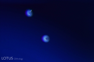 Heat-altered “snowball” like crystals in a heat-treated sapphire from Sri Lanka.