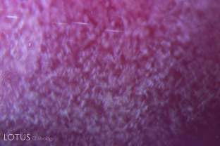 Rubies from Myanmar’s Mong Hsu region only rarely feature rutile silk. Instead, the silk-like exsolved particles are composed tiny particles of the mineral diaspore—α-AlO(OH). Diaspore gets its name from the Greek word “to scatter,” in allusion to its propensity to decrepitate (audibly pop) when heated. Diaspore silk is extremely heat sensitive and its alteration can help identify heat treatment.