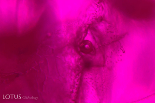A large gas bubble trapped within the glass filling a large cavity of this treated Mozambique ruby. Flux-healed fingerprints can also be seen nearby.