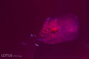This small yellowish crystal in a Thai/Cambodian ruby offers proof that the stone has not been subjected to heat treatment. After heating, the crystal would melt into a glass.