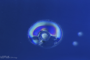 These melted snowball crystals with glassy discoids provide evidence of heat treatment in this Sri Lanka sapphire.